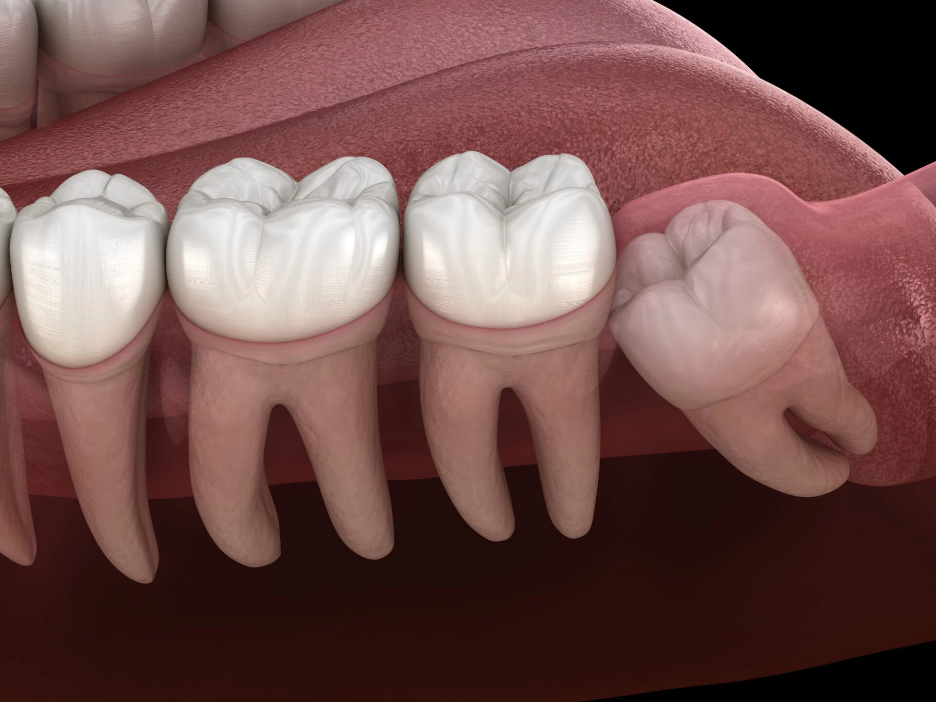 Signs That You May Need a Wisdom Tooth Removal: Key Symptoms to Watch For