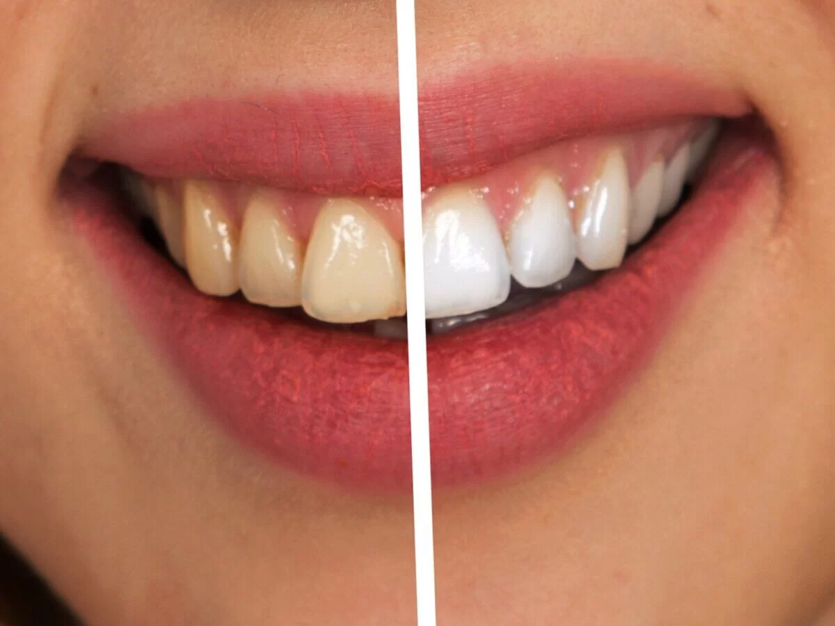 What Causes Teeth to Yellow and How to Reverse It: Effective Whitening Tips