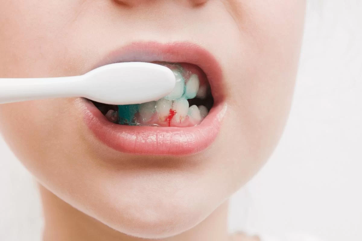 Why Do Your Gums Bleed When Brushing Your Teeth? Understanding the Causes and Solutions