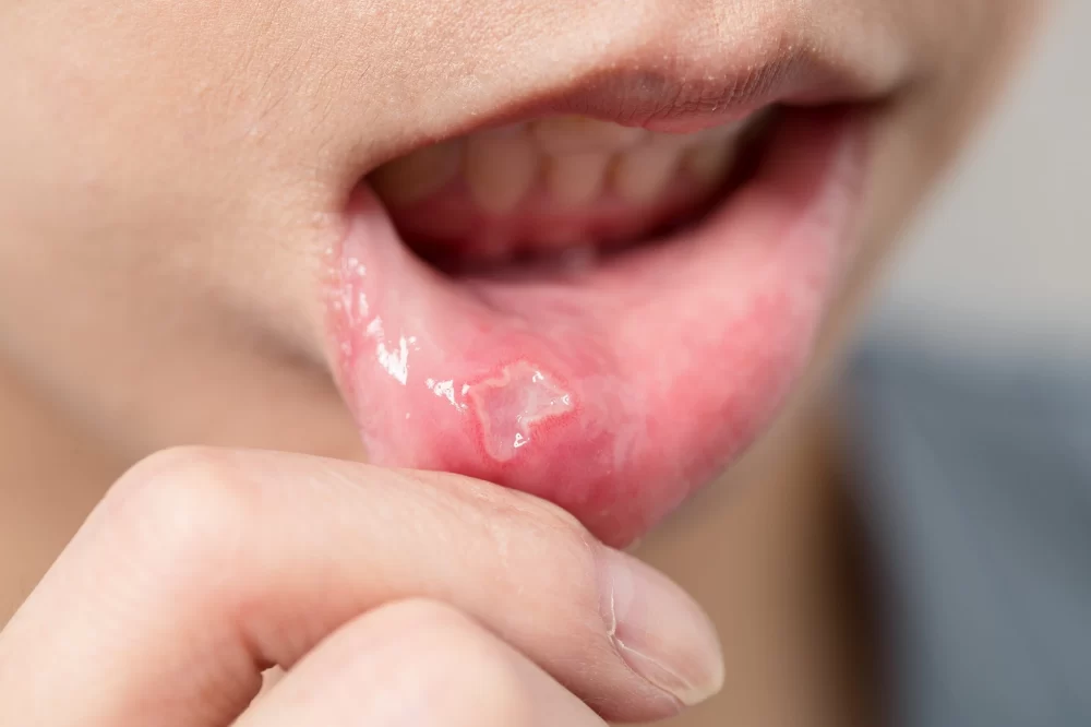 How to Effectively Treat and Prevent Canker Sores: A Comprehensive Guide