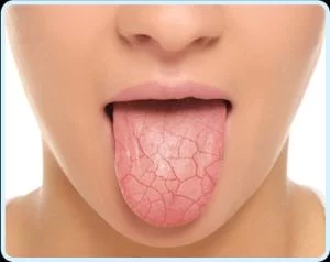 How to Manage Dry Mouth (Xerostomia) – Effective Tips and Treatments