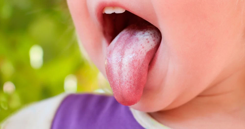Oral Thrush Causes and Treatments – Understanding and Overcoming Oral Fungal Infections