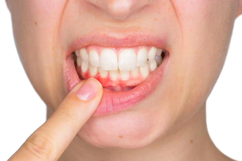 Gingivitis vs. Periodontitis: What’s the Difference and How to Treat Them