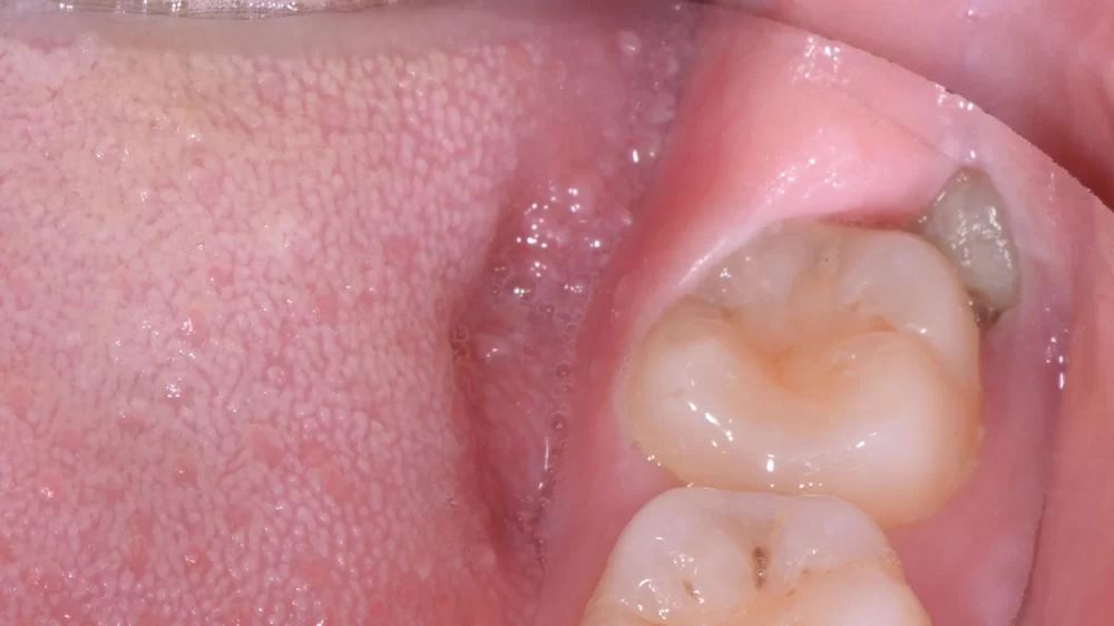 Gum Pain from Wisdom Teeth and How to Relieve It