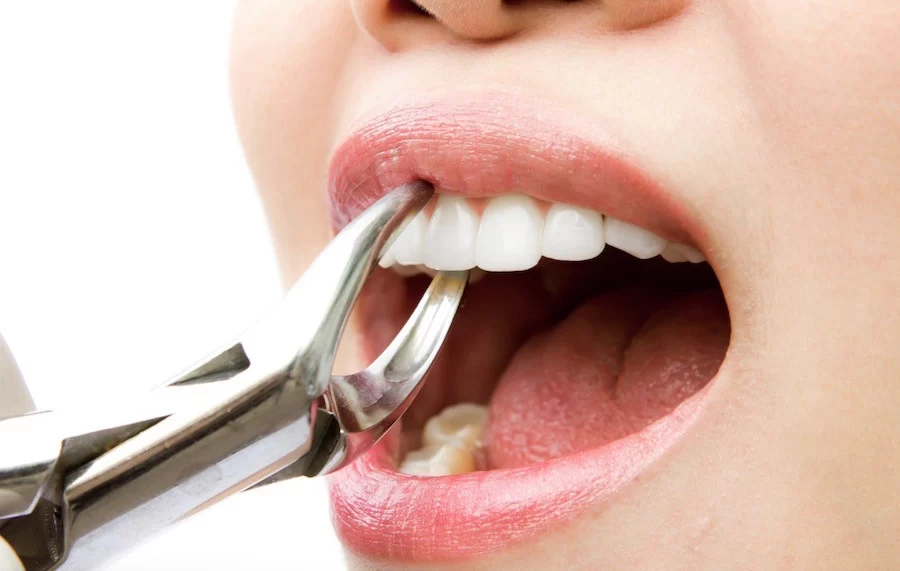 What to Do if You Lose a Tooth and How to Preserve It: Immediate Steps and Expert Advice