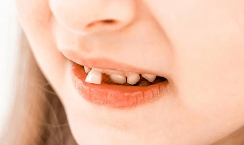 How to Handle a Lost Baby Tooth with Care and Confidence