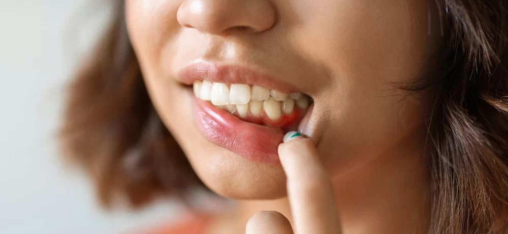 Best Treatments for Receding Gums and Tooth Loss: Restore Your Smile