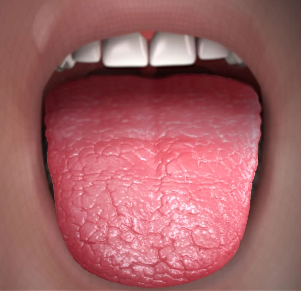 How to Recognize and Treat Dry Mouth Symptoms