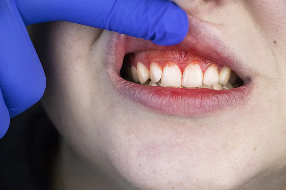 What Are the Signs of Gingivitis?