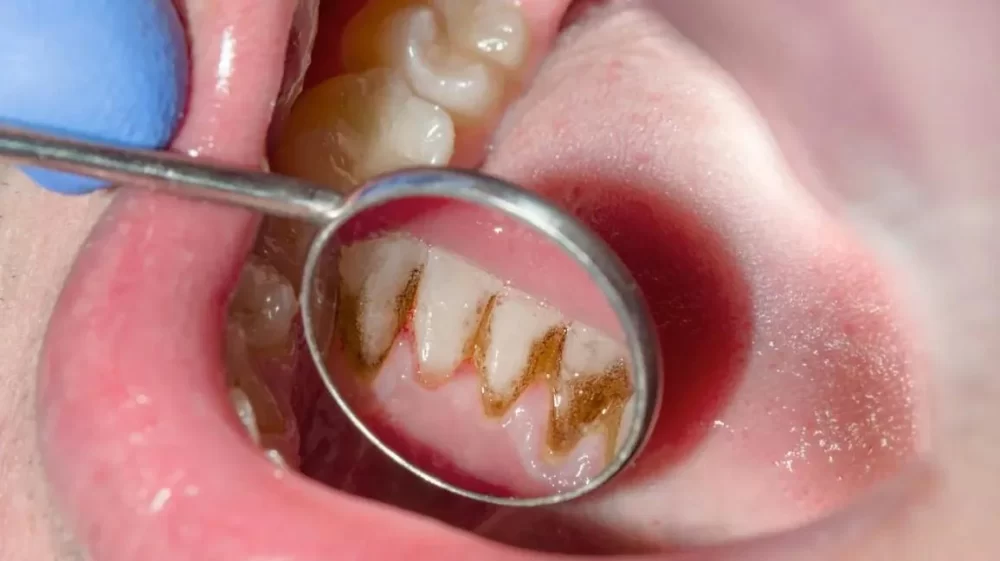Easy and Effective Ways to Prevent Gum Disease at Home