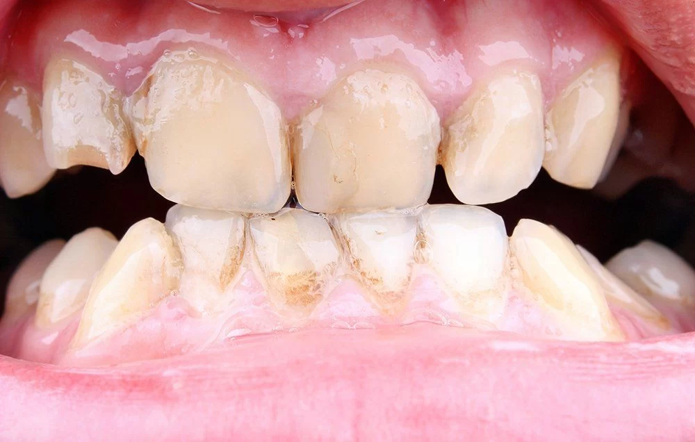 Professional Treatments for Gum Disease: How to Get the Best Care