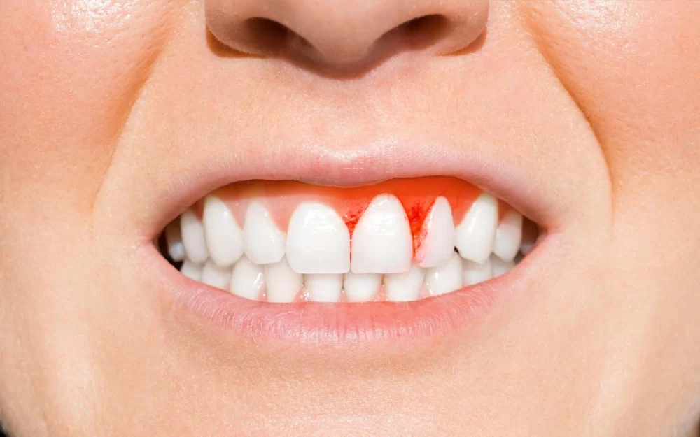 How to Prevent Gingivitis in Children: Essential Tips for Parents