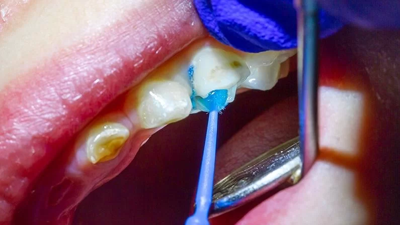 Dental Sealants for Cavity Prevention: What You Need to Know
