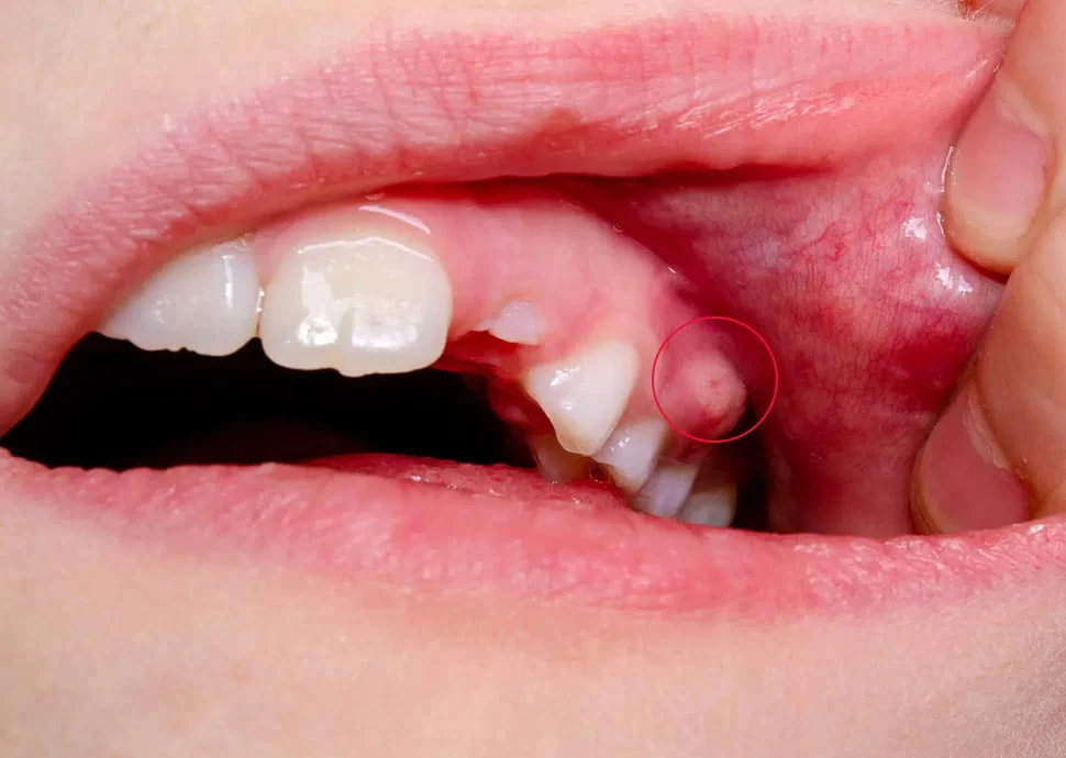 How to Reduce Pain from a Dental Abscess Before Seeing the Dentist