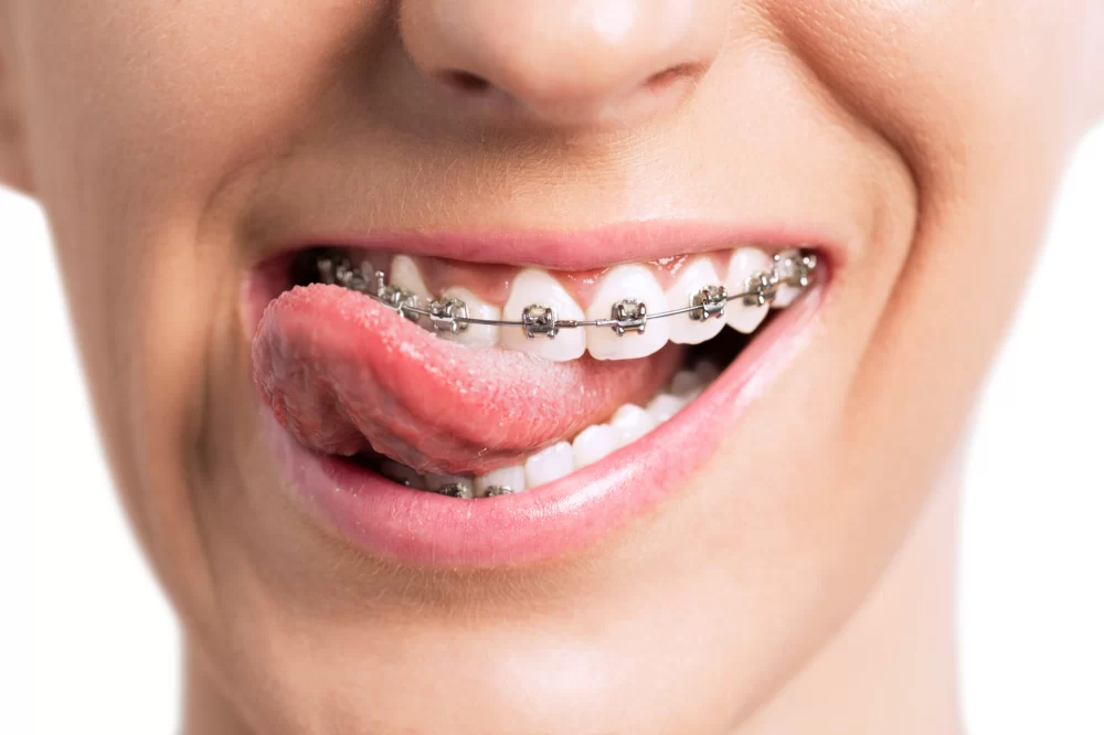 What is Involved in the Dental Orthodontic Process? Everything You Need to Know