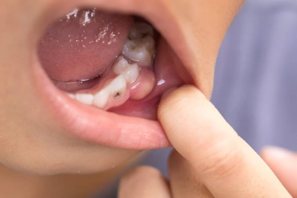 Signs of a Tooth Abscess and How to Handle an Emergency Situation