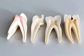 Effective Tooth Infection Treatment Without a Root Canal: Alternatives You Should Know