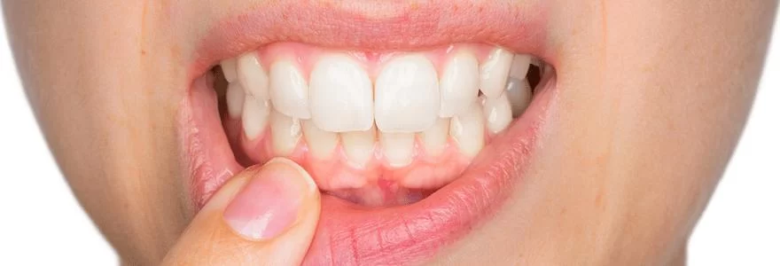 Treating and Preventing Bleeding Gums: Essential Tips for Healthy Gums