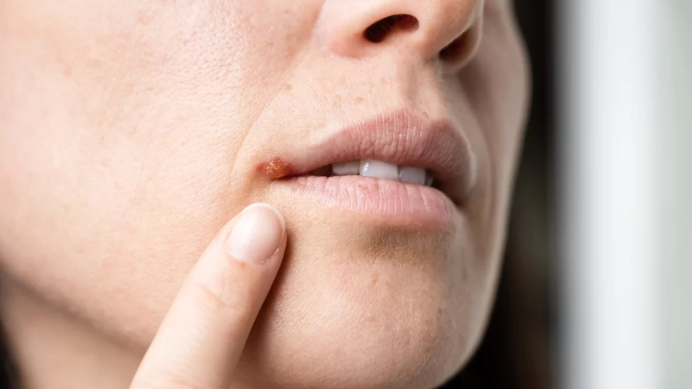 How to Treat and Prevent Cold Sores: Essential Tips and Effective Remedies