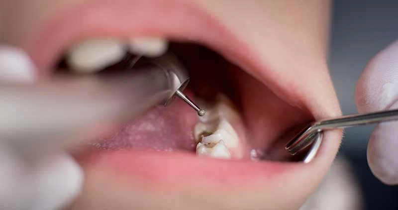 Best Oral Hygiene Habits for Preventing Dental Plaque: A Comprehensive Guide