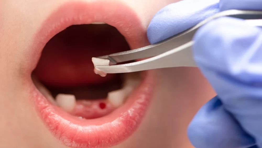 How to Care for Your Teeth After a Tooth Extraction: Essential Aftercare Tips