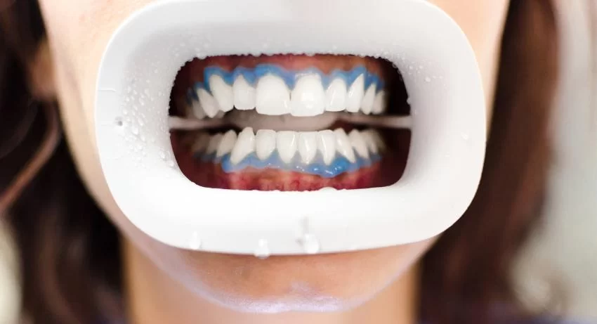 Why You Should Consider a Professional Teeth Whitening Treatment: Expert Benefits