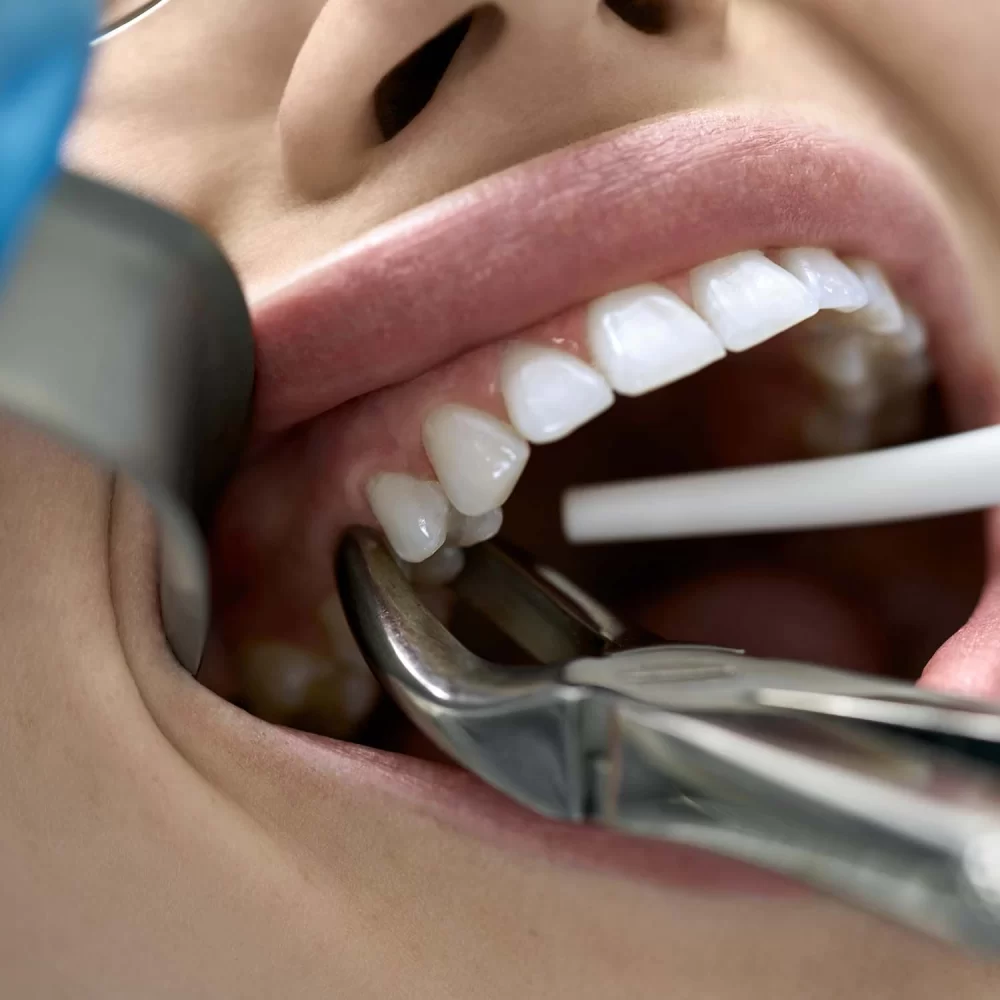 How to Care for Your Teeth After a Tooth Extraction – Essential Tips for Healing