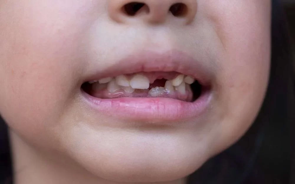 What to Do If Your Tooth Is Knocked Out: Emergency Care and Solutions