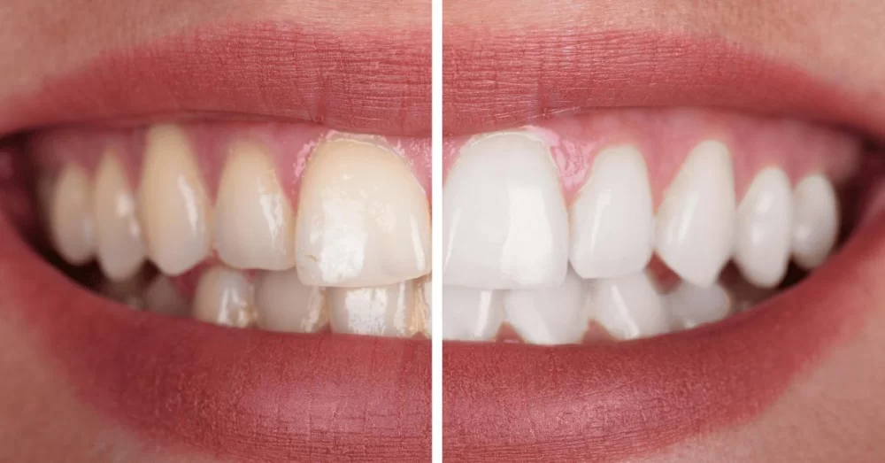 The Best Teeth Whitening Products and Their Effectiveness