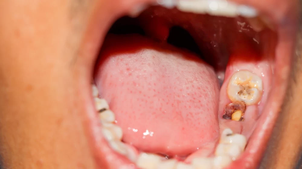 How to Naturally Treat Tooth Sensitivity at Home – Effective Remedies and Tips