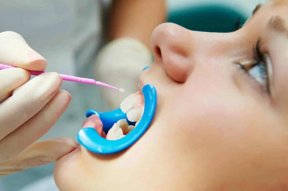Why Dental Sealants Are Crucial for Your Child's Oral Health