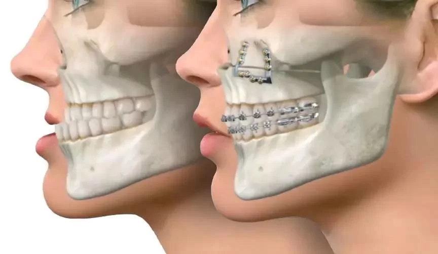 How to Navigate Dental Insurance Coverage for Procedures: A Comprehensive Guide