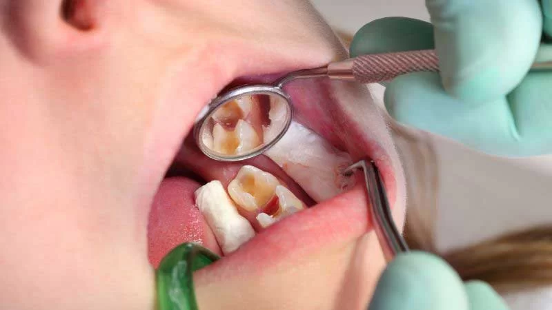 How Seniors Can Prevent Cavities with Effective Oral Hygiene Practices