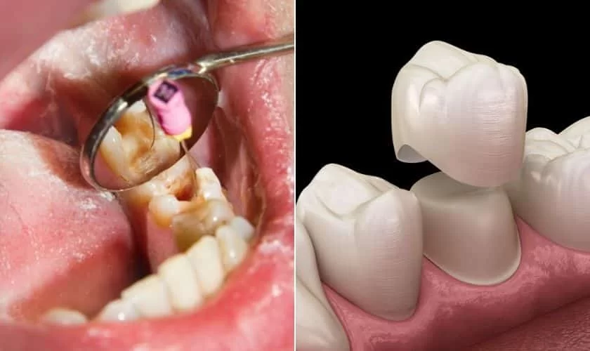 How to Prepare for a Root Canal Procedure: Essential Tips & Insights