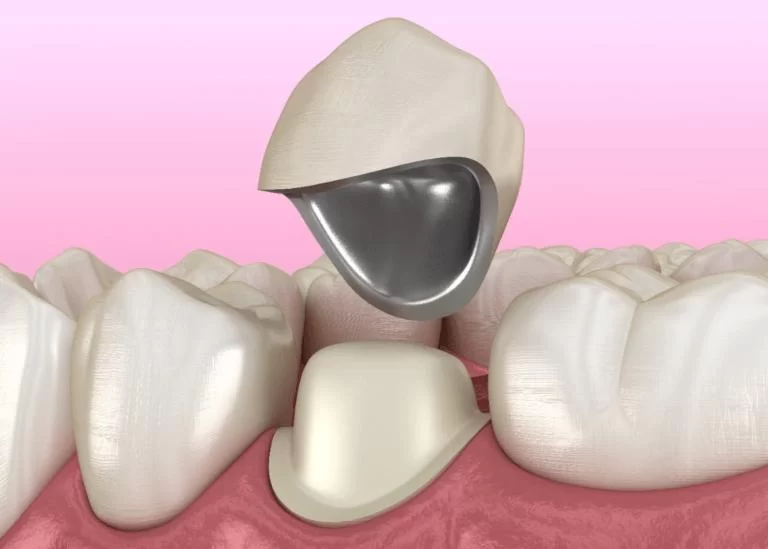 Choosing a Dentist for Senior Dental Care: How to Find the Right Dentist for Your Loved Ones