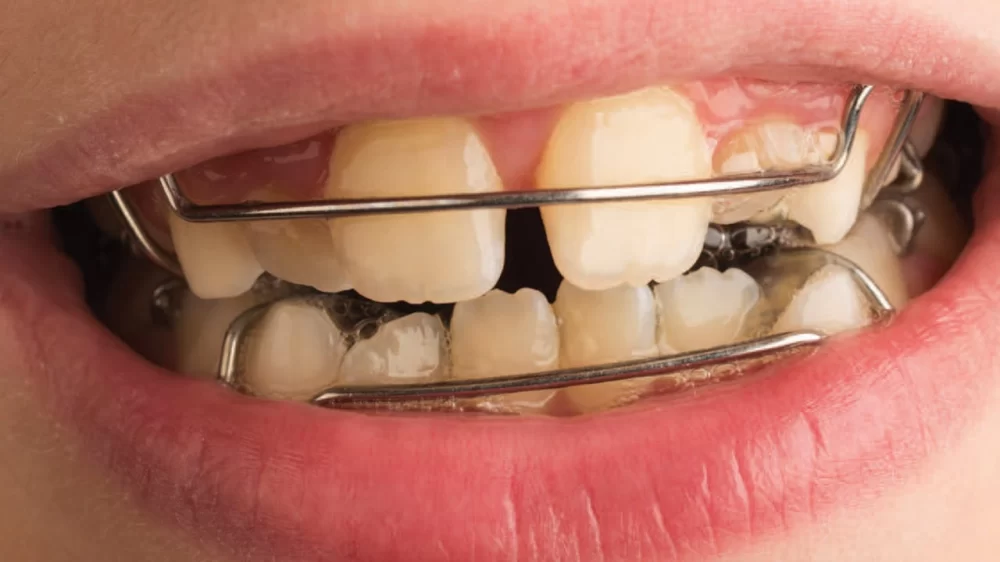 Advanced Orthodontic Treatments for Complex Bite Problems: A Detailed Overview