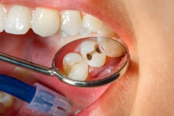 Treatment for Cavities in Teeth with Fillings - How Dental Fillings Can Restore Your Smile