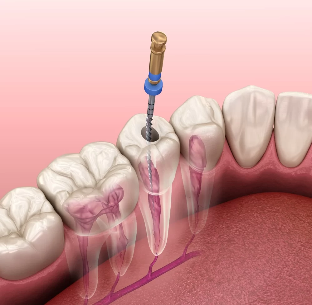 How to Treat Pulpitis: Understanding the Need for a Root Canal