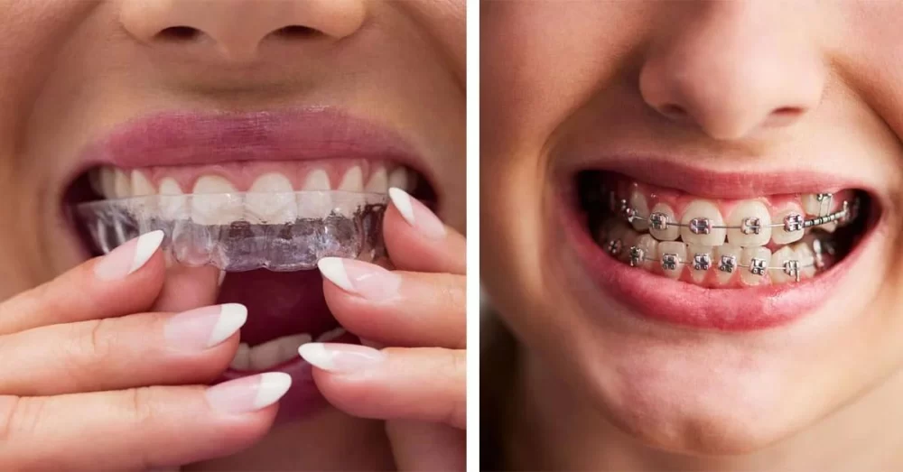How to Choose Between Traditional Braces and Clear Aligners: A Comprehensive Guide