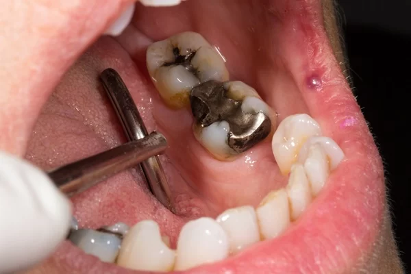 How to Know When You Need to Replace a Dental Filling: Signs and Solutions