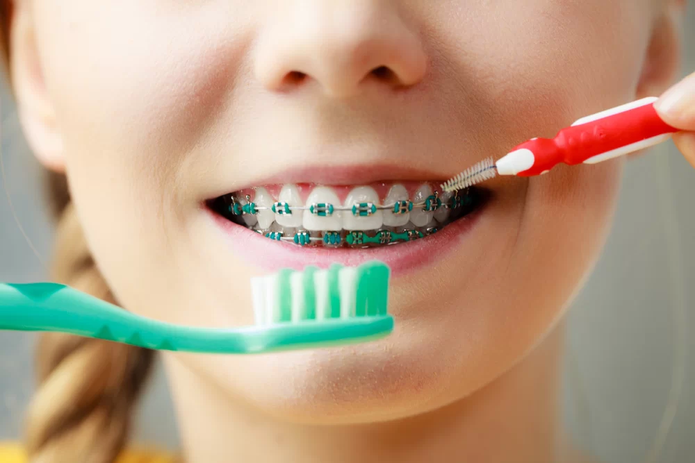 How to Maintain Oral Hygiene with Braces for a Healthier Smile