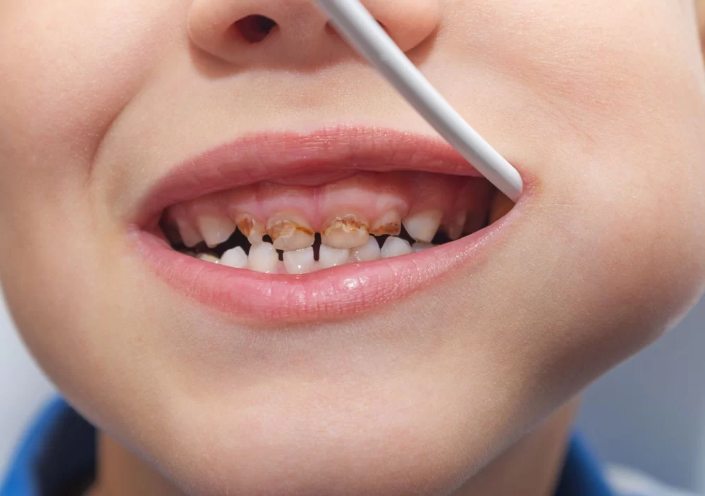 Effective Treatment for Cavities in Baby Teeth That Are About to Fall Out