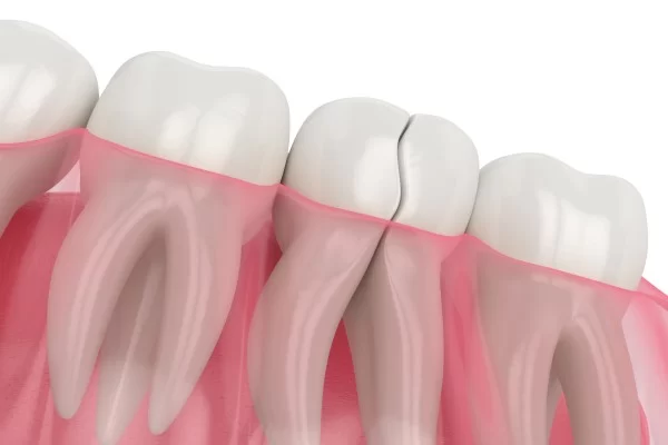 Restorative Dentistry for Broken Teeth: Repair and Restore Your Smile