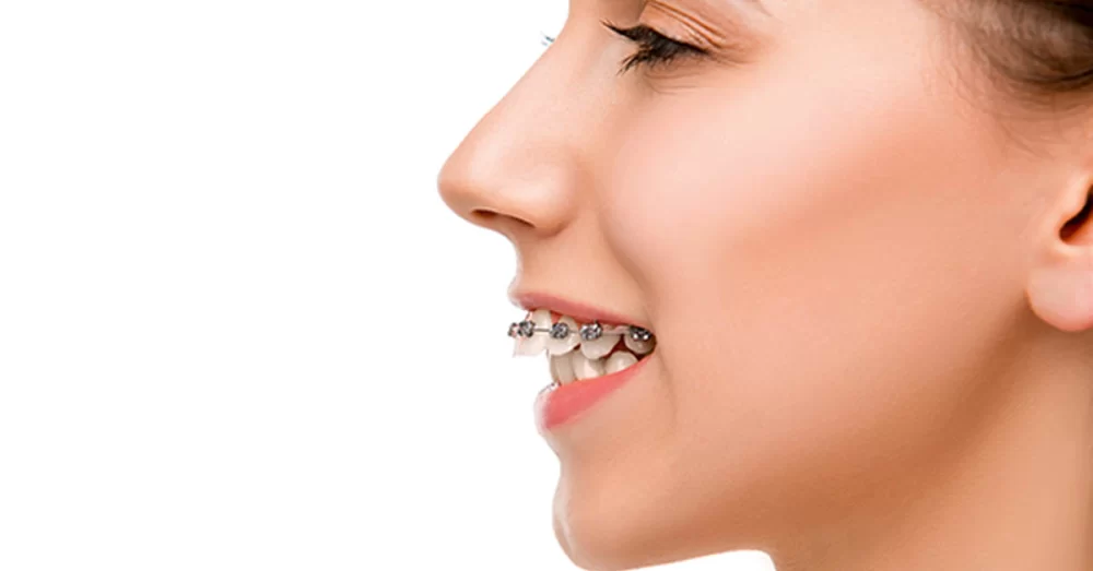 Orthodontic Treatments for Overbite Correction: A Complete Guide