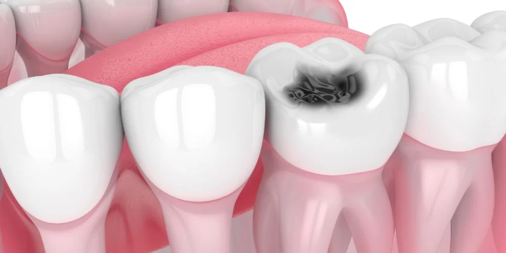 Answers to Common Questions About Dental Cavities and Prevention