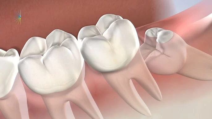 Trusted Dentist for Wisdom Teeth Removal in Oklahoma City, OK