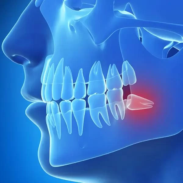 Trusted Dentist for Wisdom Teeth Removal in Minneapolis, MN