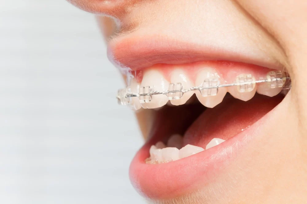 Find a Trusted Orthodontist in Austin, TX for Your Perfect Braces