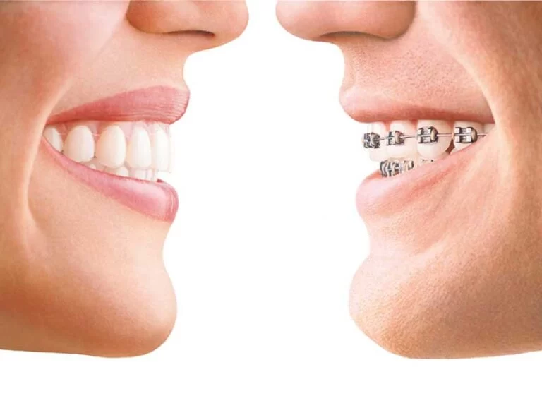 Reliable Orthodontic Services in Kansas City, MO: Expert Care for Your Smile