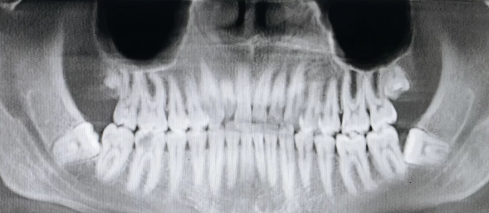 The Role of X-rays in Dentistry: Are They Safe?